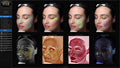 Visia Skin Analysis