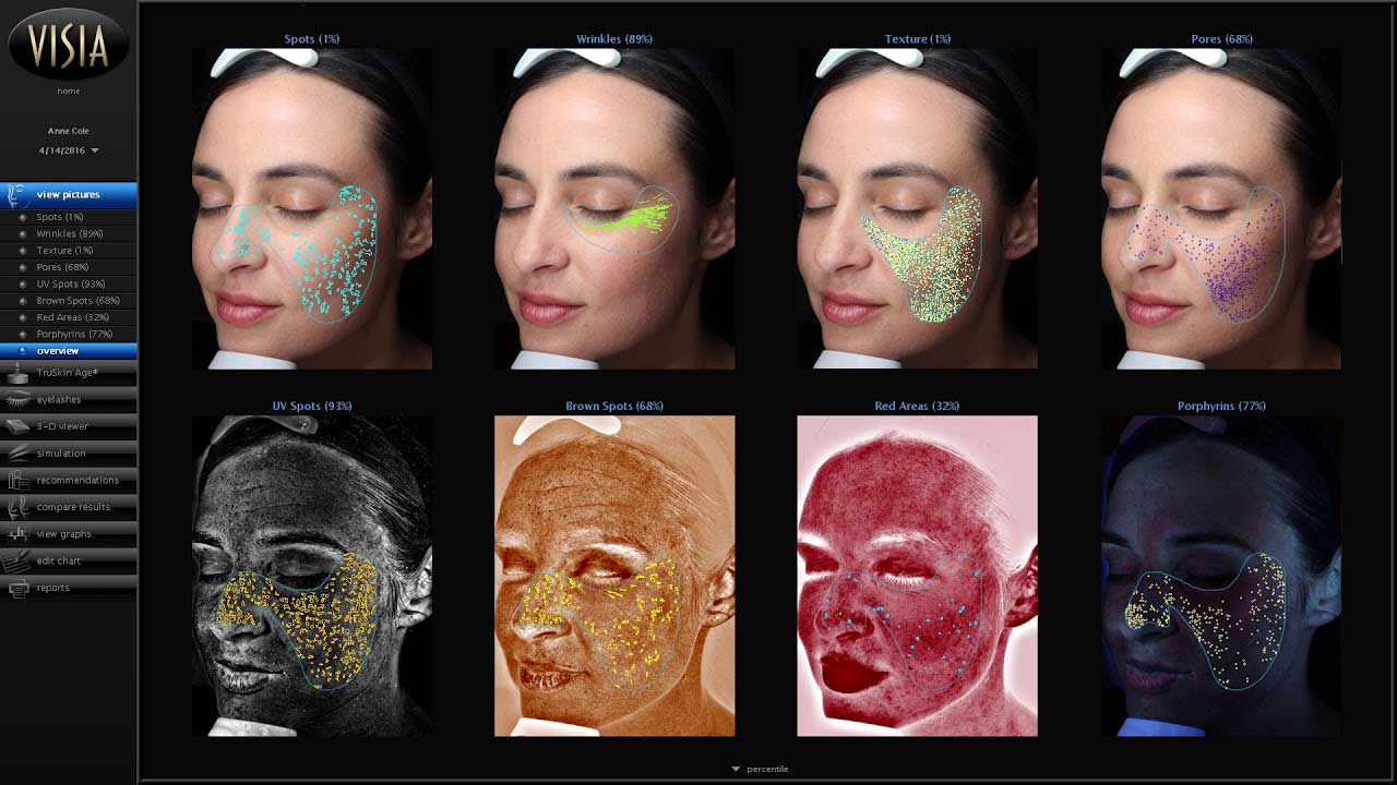 Visia Skin Analysis